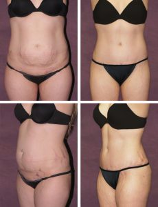 Dr. Patronella often is able to eliminate or diminish the appearance of stretch marks for patients through a True Form Tummy Tuck® procedure, as these photos show. With this procedure, which this patient had in conjunction with liposuction of the waist and outer thighs, Dr. Patronella restored a toned appearance to her abdomen by removing loose skin and tightening the underlying abdominal muscle wall, which is stretched out during pregnancy. 