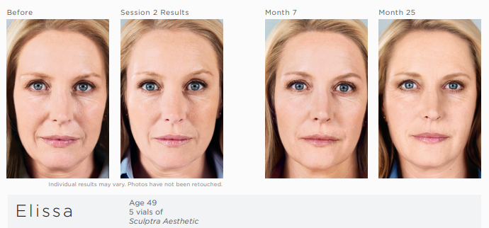 Elissa, 25 months after her first Sculptra Aesthetic injection