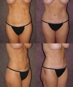 Dr. Patronella performed a revision tummy tuck to give this woman a smoother skin tone after a prior Smartlipo procedure left her with skin contour irregularity.