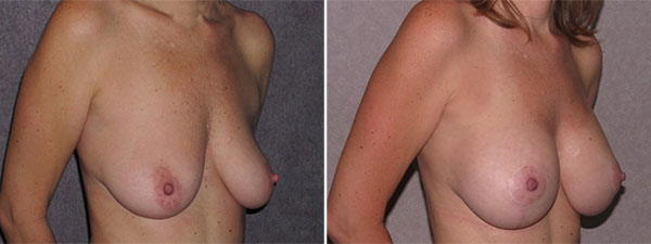 Breast Augmentation Before and After Photos - Patient 2 Side view