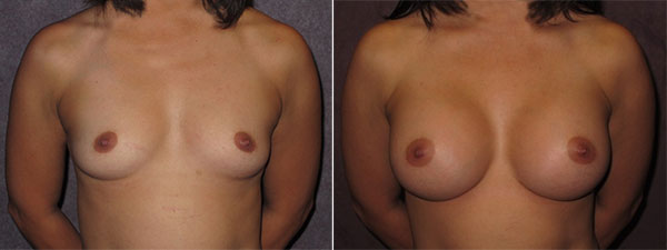 Breast Augmentation Before and After Patient Photos