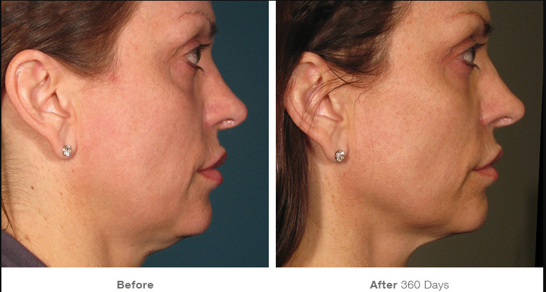 Before and After Ultherapy