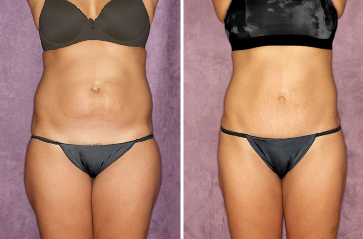Study Confirms What Women Know: Tummy Tuck + Liposuction = Extreme