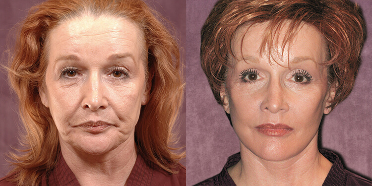 Cosmetic Injectables Before and After Patient Photos