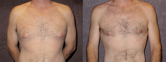 Gynecomastia Before and After Patient Photos