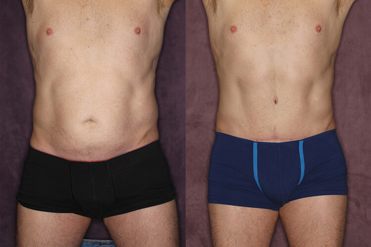 Fotografías del antes y después de la Abdominoplastia para Hombres