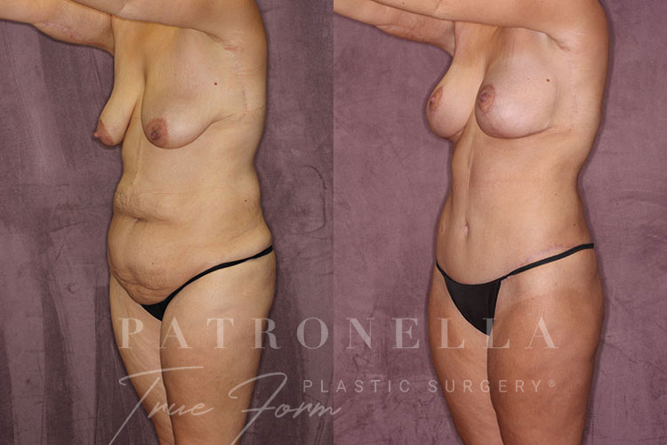 True Form Tummy Tuck Before and After Results Side View by Dr. Patronella