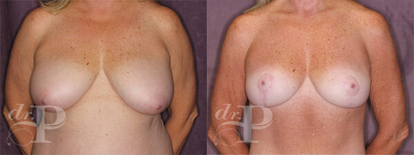 Breast Reduction Before and After Patient Photos