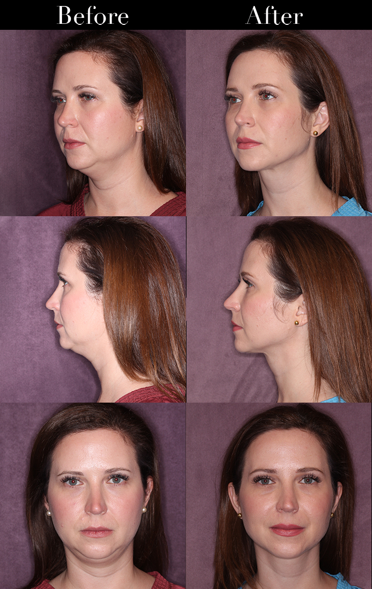 Sculpt a chiseled face #skincare #facesculpting #jawline