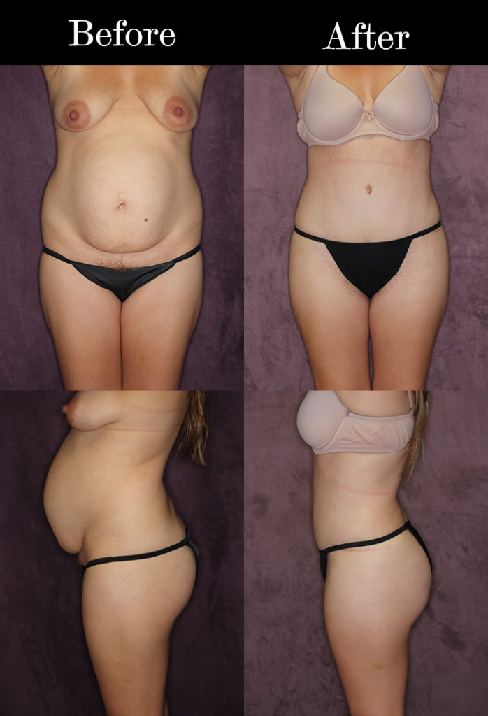 Is a Brazilian Butt Lift Safe?: Advanced Plastic Surgery Center