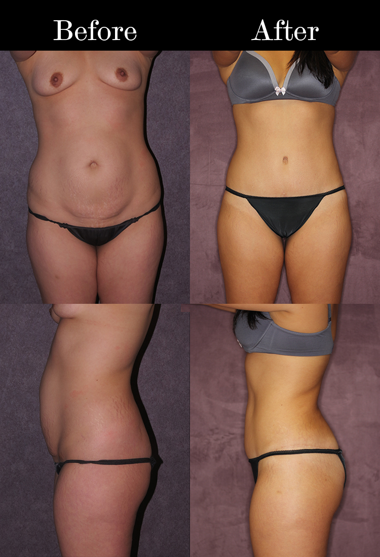 The Tummy Tuck Scar and Dr. Patronella's TRUE FORM ABDOMINOPLASTY