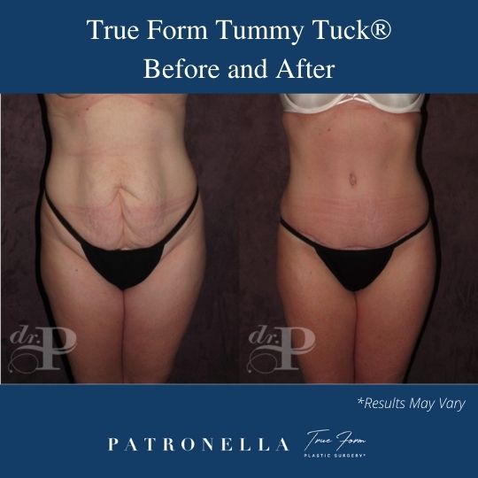 Before and after image showing the results of a True Form Tummy Tuck performed in Dallas.
