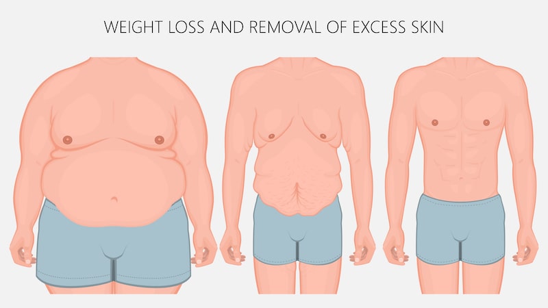 A graphic showing why removing excess skin helps after significant weight loss.