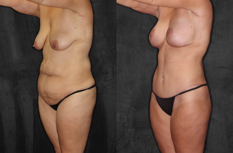 True Form Tummy Tuck Patient