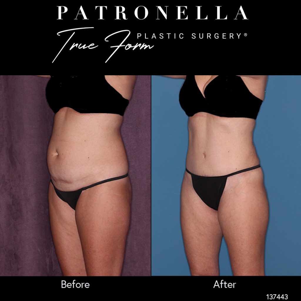 Before and after photo of a true form tummy tuck patient,