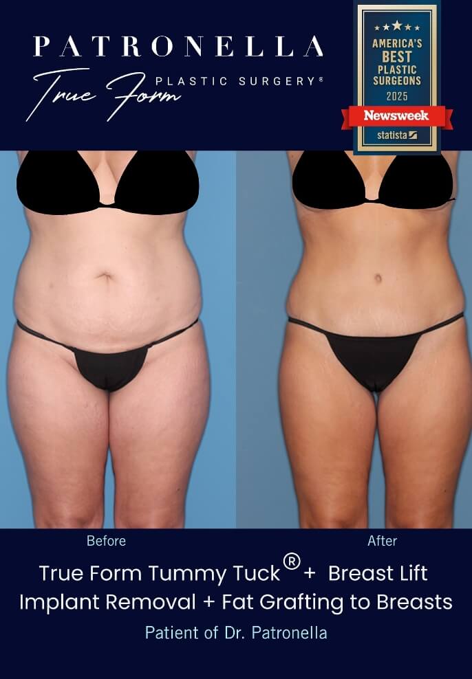 Before and After Tummy Tuck by Houston Texas Top Cosmetic Plastic Surgeon