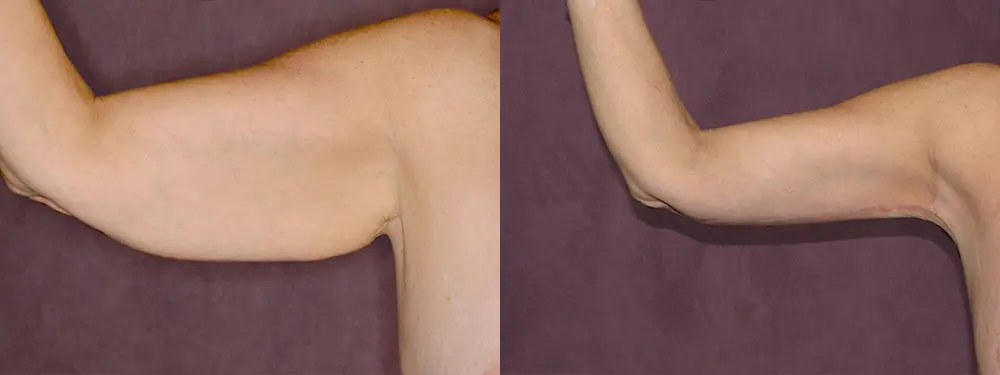 Before and after of arm lift