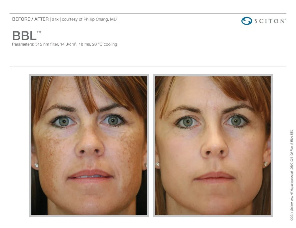 BBL™ + Halo™ Patient Before & After