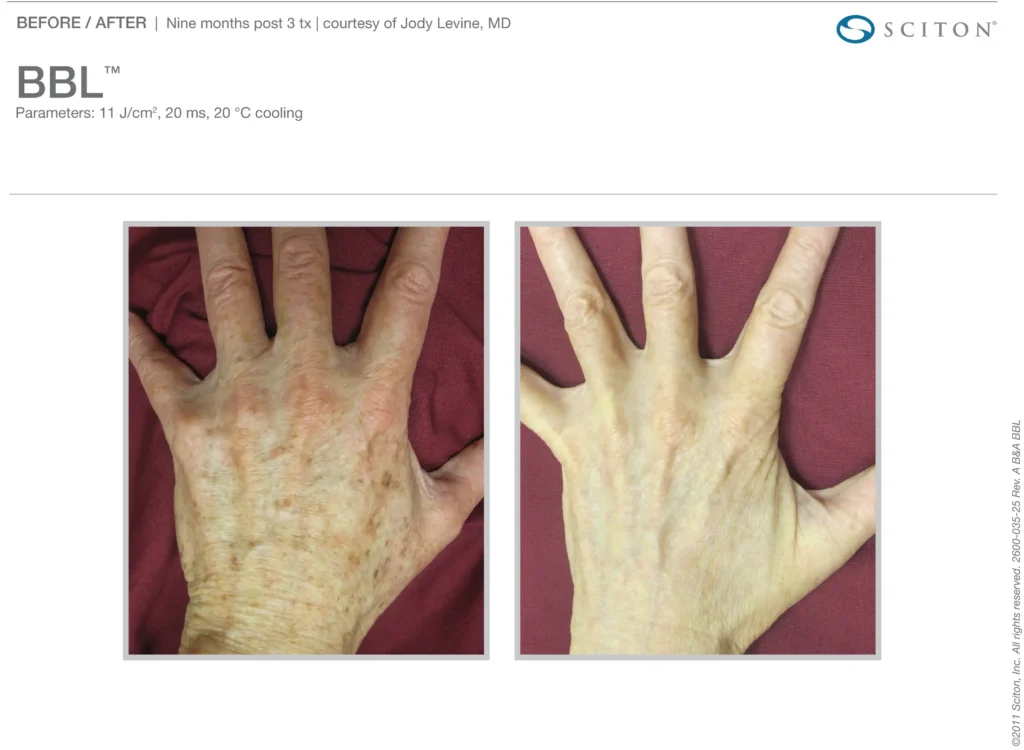 BBL™ Patient Before & After