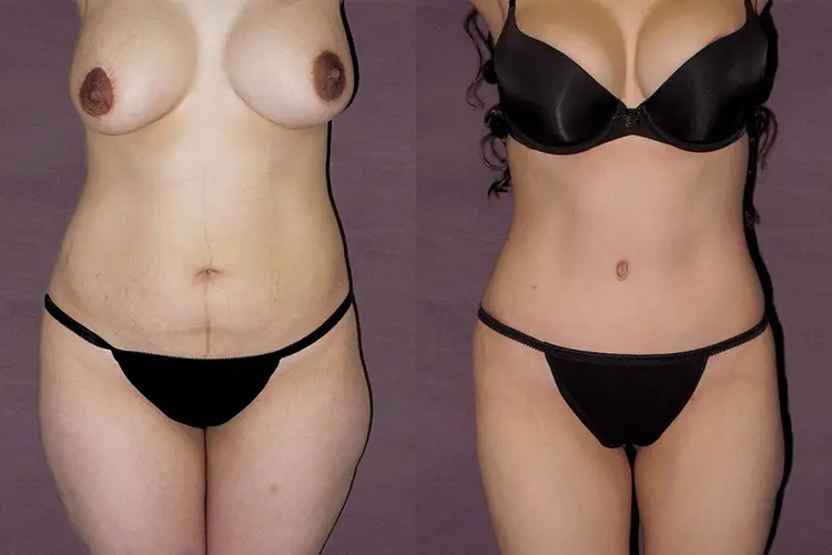 Before and after of body lift