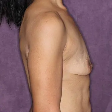 side breast