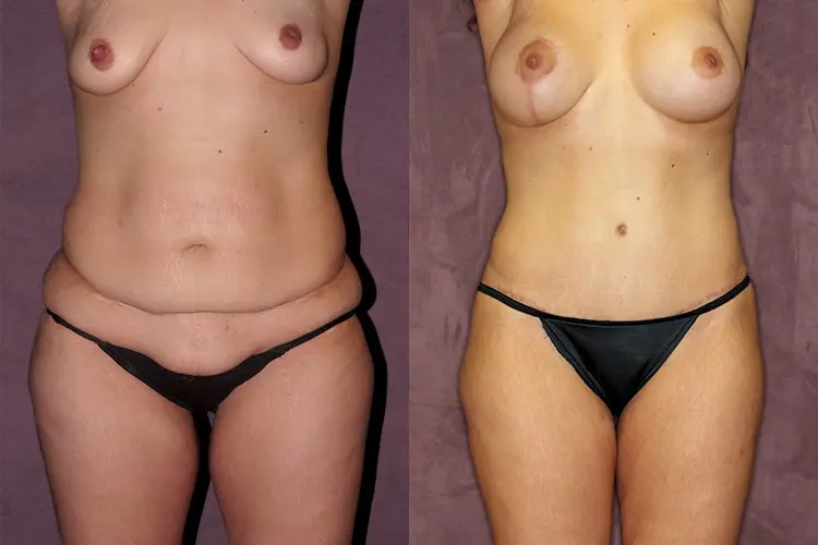 Before and after of tummy tuck