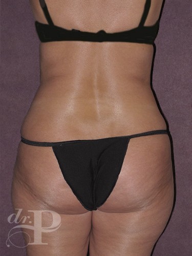 Case--1151 | Before True Form Tummy Tuck® 4