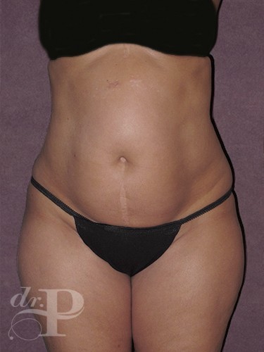 Case--1151 | Before True Form Tummy Tuck® 1