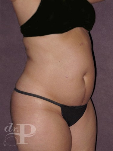 Case--1161 | Before Liposuction 2