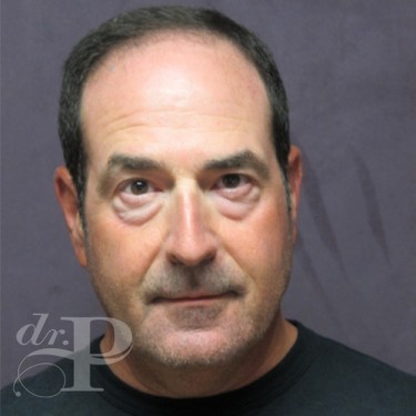 Case--29562 | Before Eyelid Surgery (Blepharoplasty) 1