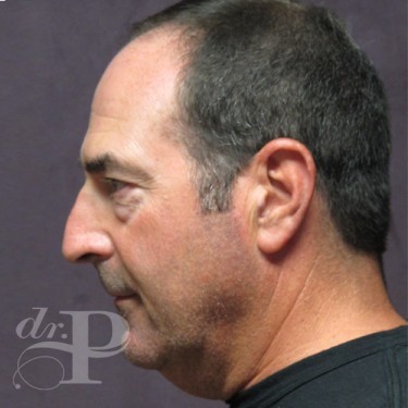 Case--29562 | Before Eyelid Surgery (Blepharoplasty) 3