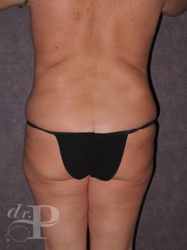 Case--29214 | Before True Form Tummy Tuck® with Lower Body Lift (Buttock Lift) 4