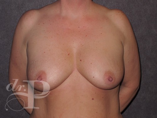 Case--29018 | Before Breast Augmentation 1