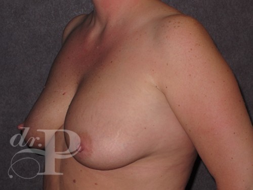 Case--29018 | Before Breast Augmentation 2
