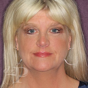 Case--28119 | After Eyelid Surgery (Blepharoplasty) 1