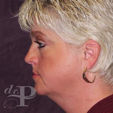 Case--28119 | Before Eyelid Surgery (Blepharoplasty) 3