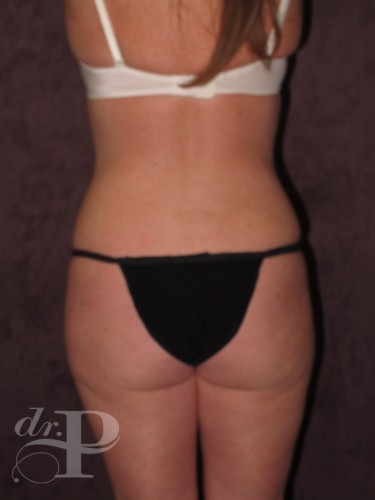 Case--1854 | After True Form Tummy Tuck® 4