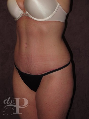 Case--1854 | After True Form Tummy Tuck® 2