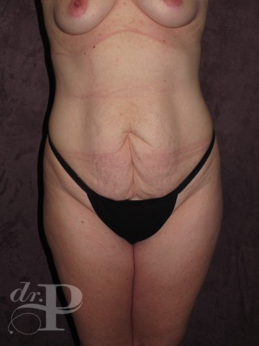 Case--1854 | Before True Form Tummy Tuck® 1
