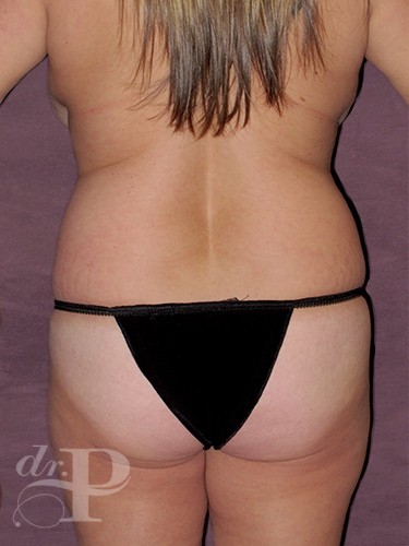 Case--2090 | Before Liposuction 4