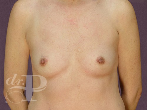 Case--28669 | Before Breast Augmentation 1