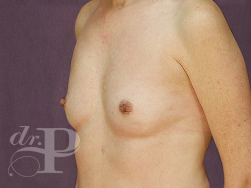 Case--28669 | Before Breast Augmentation 2