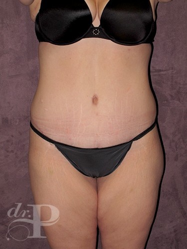 Case--29998 | After Lower Body Lift (Buttock Lift) 1