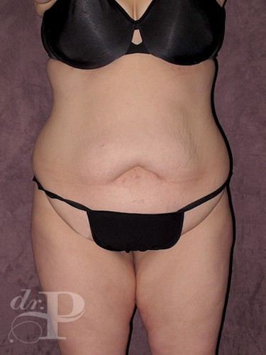Case--1557 | Before Liposuction 1