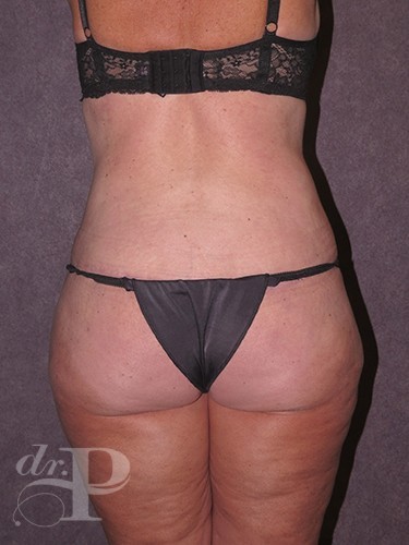 Case--30491 | After True Form Tummy Tuck® with Lower Body Lift (Buttock Lift) 4