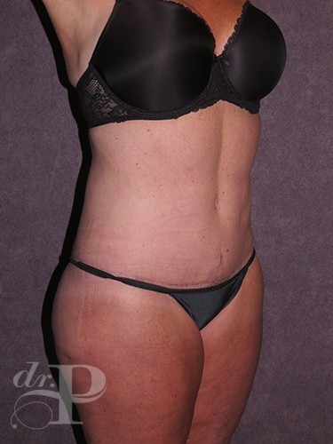 Case--30491 | After True Form Tummy Tuck® with Lower Body Lift (Buttock Lift) 2