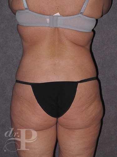 Case--1466 | Before Liposuction 4