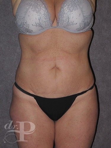 Case--1466 | Before Liposuction 1