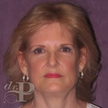 Case--30061 | After Facelift and Neck Lift 1