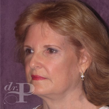 Case--30061 | After Facelift and Neck Lift 2